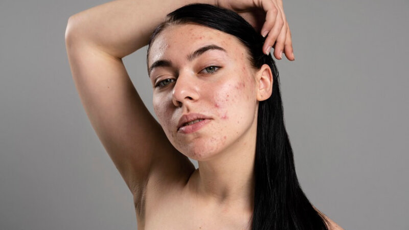 How To Deal With Acne on Face?